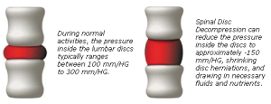 spinal decompression